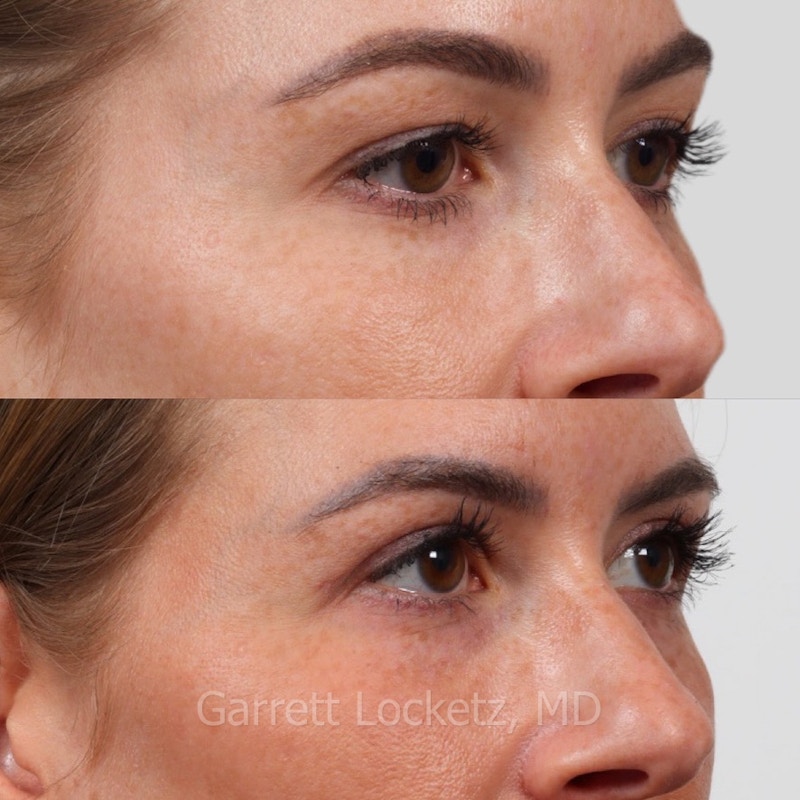 Eyelid Surgery (Blepharoplasty) Before & After Gallery - Patient 196499746 - Image 1