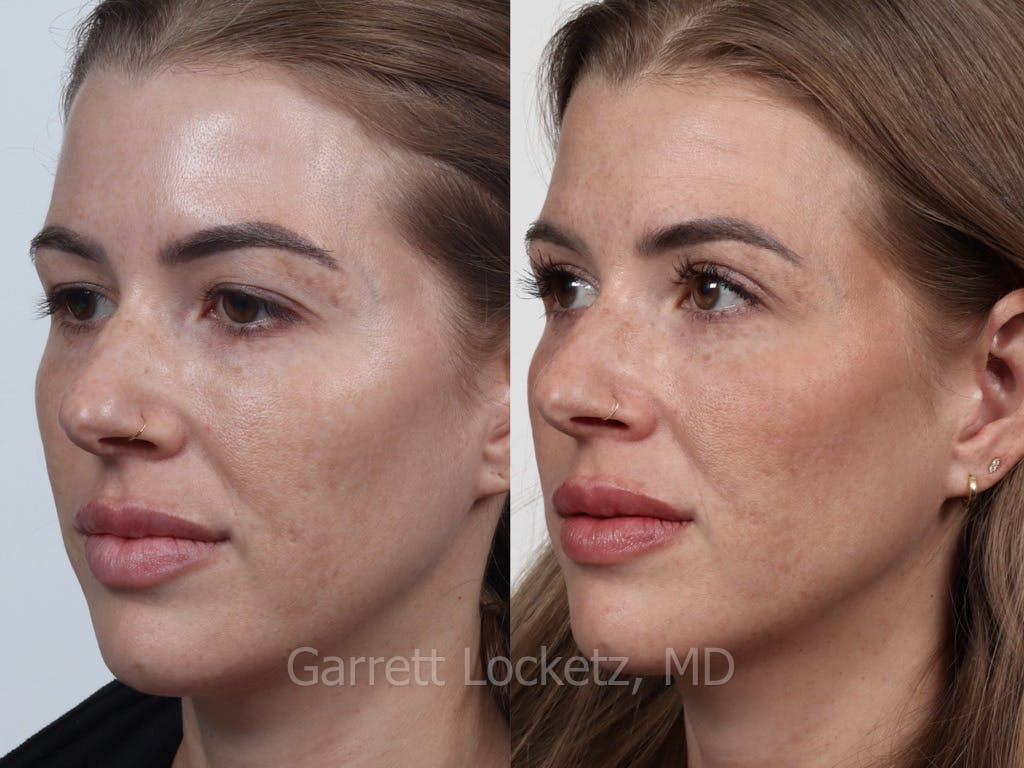 Eyelid Surgery (Blepharoplasty) Before & After Gallery - Patient 196499747 - Image 1