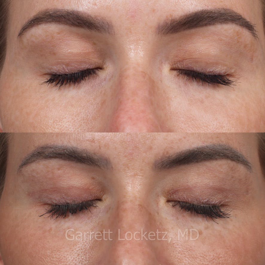 Eyelid Surgery (Blepharoplasty) Before & After Gallery - Patient 196499748 - Image 1