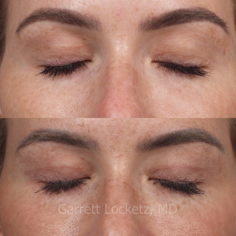 Eyelid Surgery (Blepharoplasty) Before & After Gallery - Patient 196499748 - Image 1