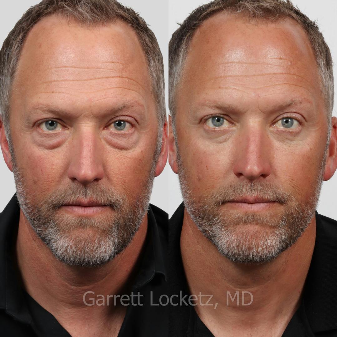 Eyelid Surgery (Blepharoplasty) Before & After Gallery - Patient 196499749 - Image 1