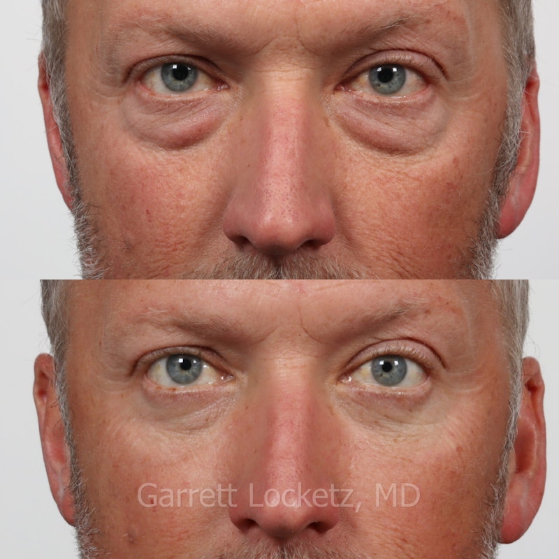 Eyelid Surgery (Blepharoplasty) Before & After Gallery - Patient 196499750 - Image 1