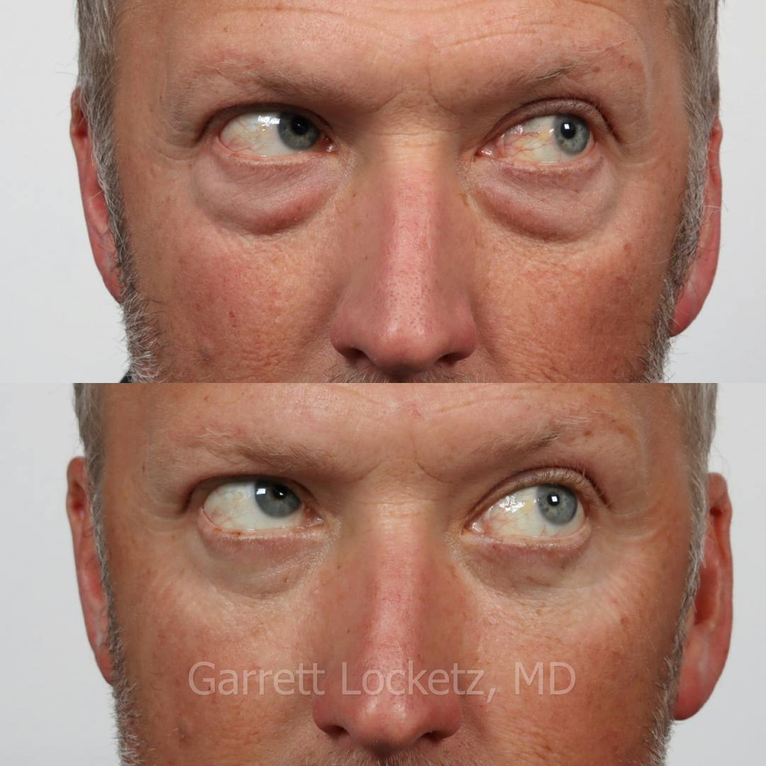 Eyelid Surgery (Blepharoplasty) Before & After Gallery - Patient 196499751 - Image 1