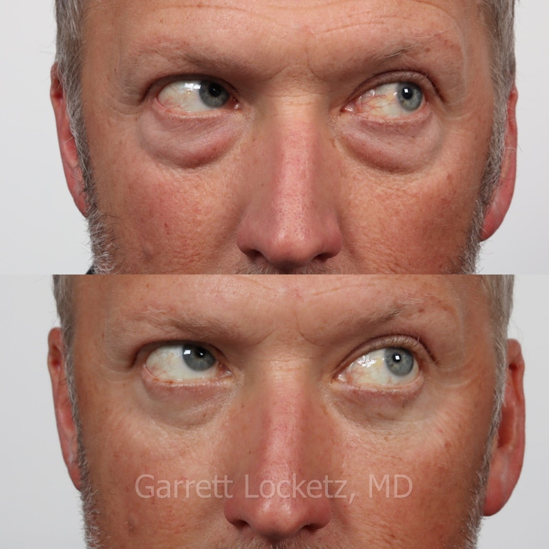 Eyelid Surgery (Blepharoplasty) Before & After Gallery - Patient 196499751 - Image 1
