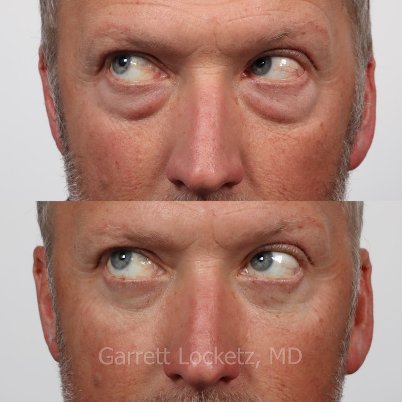 Eyelid Surgery (Blepharoplasty) Before & After Gallery - Patient 196499752 - Image 1