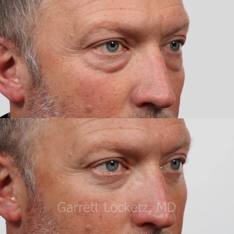 Eyelid Surgery (Blepharoplasty) Before & After Gallery - Patient 196499753 - Image 1