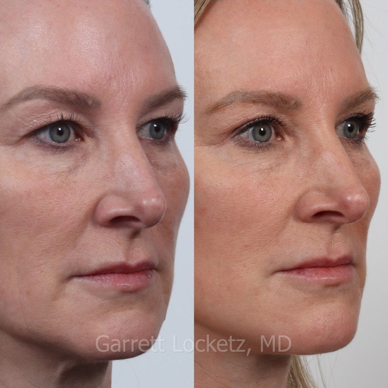Eyelid Surgery (Blepharoplasty) Before & After Gallery - Patient 196499756 - Image 1
