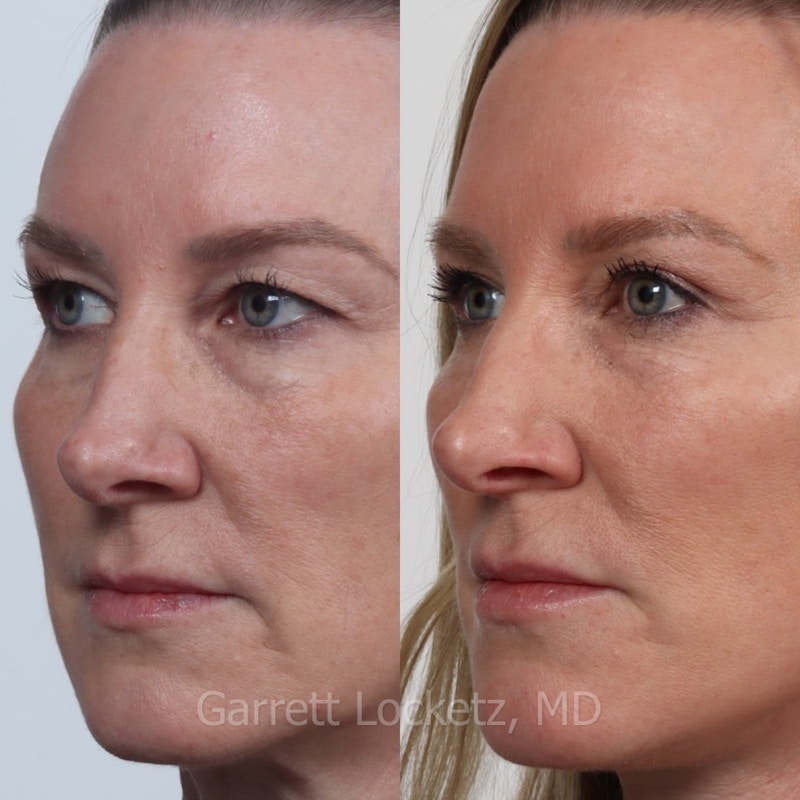 Eyelid Surgery (Blepharoplasty) Before & After Gallery - Patient 196499757 - Image 1