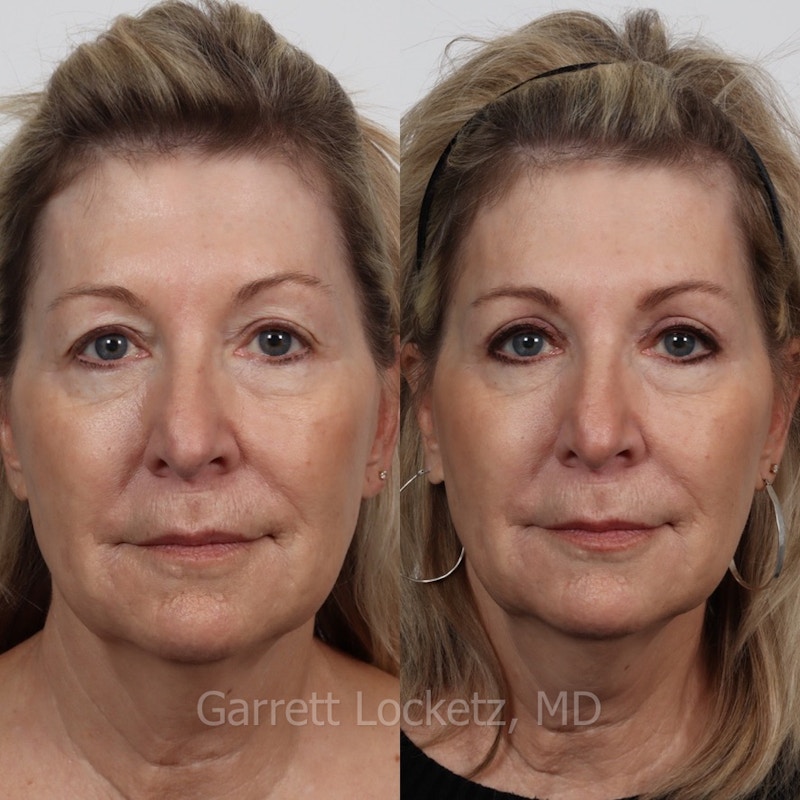Eyelid Surgery (Blepharoplasty) Before & After Gallery - Patient 196499758 - Image 1