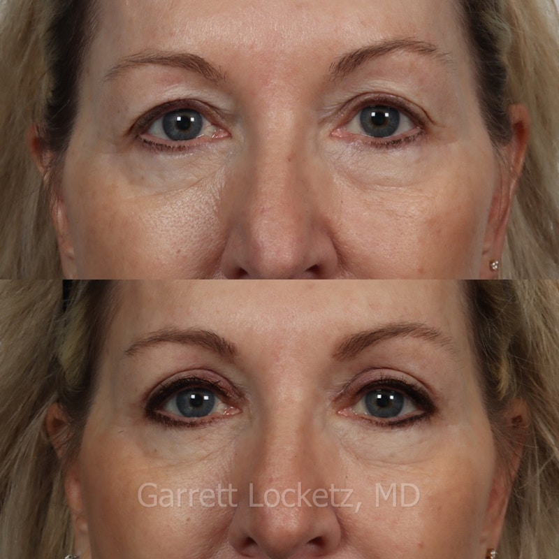 Eyelid Surgery (Blepharoplasty) Before & After Gallery - Patient 196499759 - Image 1