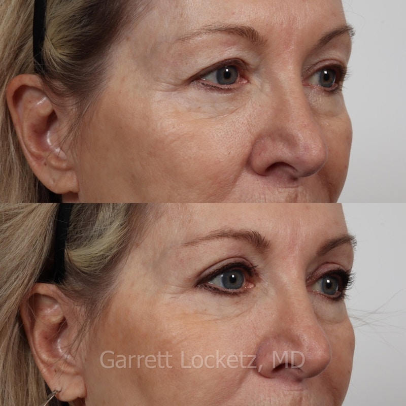 Eyelid Surgery (Blepharoplasty) Before & After Gallery - Patient 196499760 - Image 1