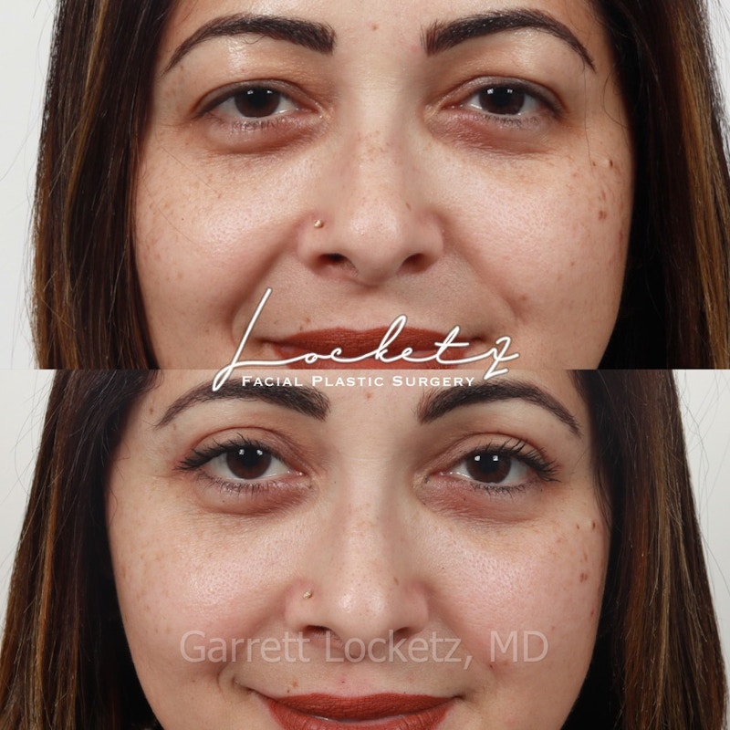 Eyelid Surgery (Blepharoplasty) Before & After Gallery - Patient 196499761 - Image 1