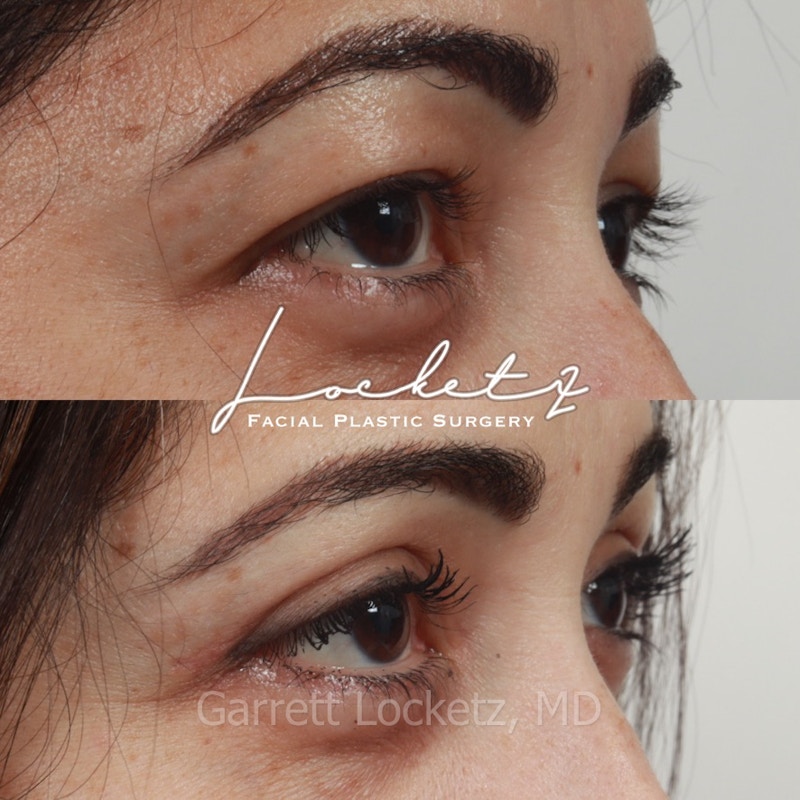 Eyelid Surgery (Blepharoplasty) Before & After Gallery - Patient 196499762 - Image 1