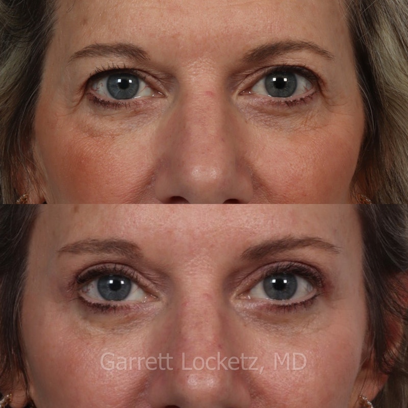 Eyelid Surgery (Blepharoplasty) Before & After Gallery - Patient 196499765 - Image 1