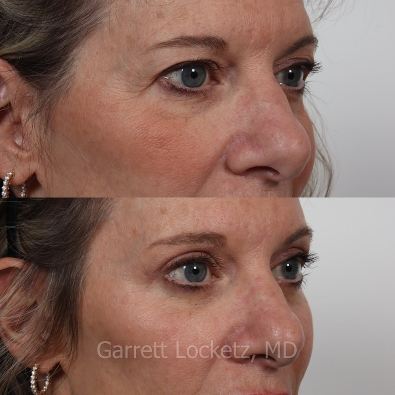 Eyelid Surgery (Blepharoplasty) Before & After Gallery - Patient 196499766 - Image 1
