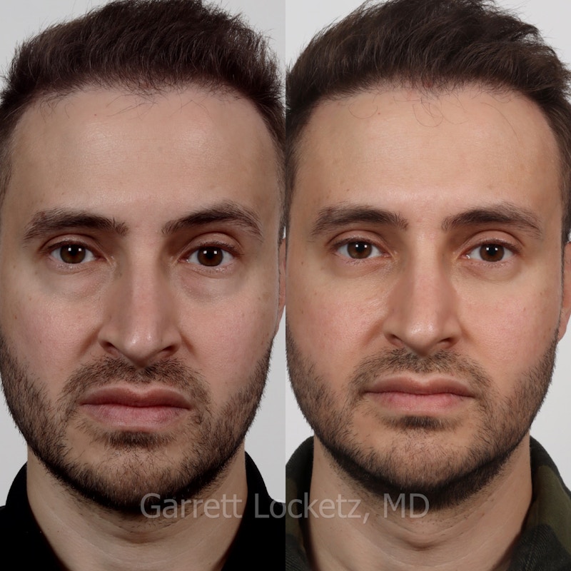 Eyelid Surgery (Blepharoplasty) Before & After Gallery - Patient 196499767 - Image 1