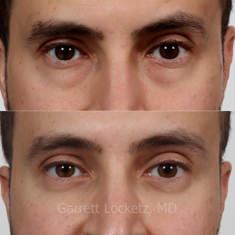 Eyelid Surgery (Blepharoplasty) Before & After Gallery - Patient 196499768 - Image 1