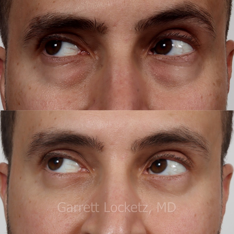 Eyelid Surgery (Blepharoplasty) Before & After Gallery - Patient 196499769 - Image 1
