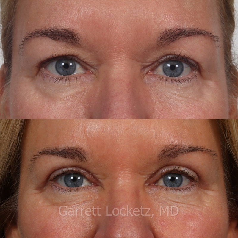 Eyelid Surgery (Blepharoplasty) Before & After Gallery - Patient 196499770 - Image 1
