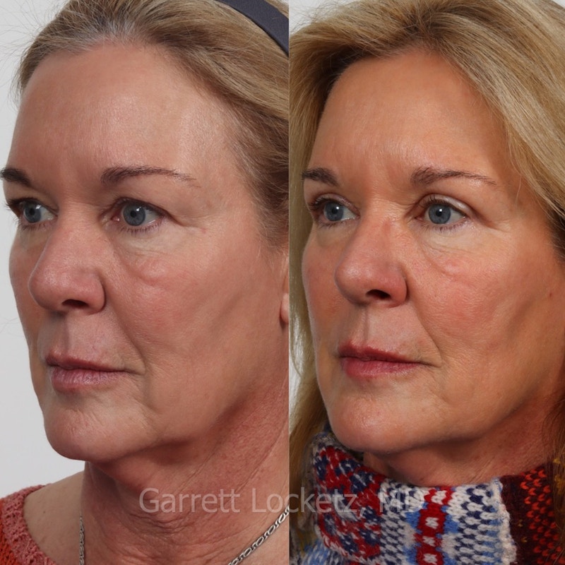 Eyelid Surgery (Blepharoplasty) Before & After Gallery - Patient 196499771 - Image 1