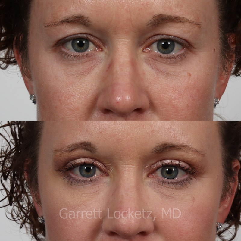 Eyelid Surgery (Blepharoplasty) Before & After Gallery - Patient 196499772 - Image 1