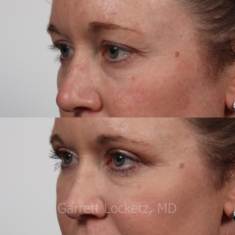 Eyelid Surgery (Blepharoplasty) Before & After Gallery - Patient 196499773 - Image 1