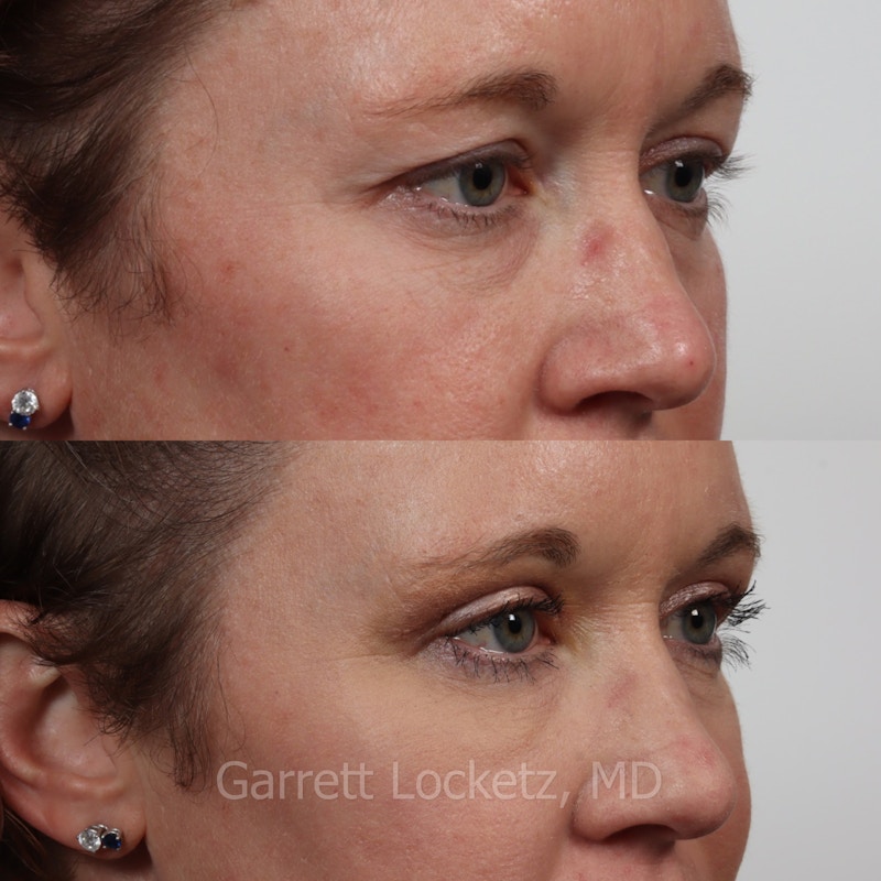 Eyelid Surgery (Blepharoplasty) Before & After Gallery - Patient 196499774 - Image 1