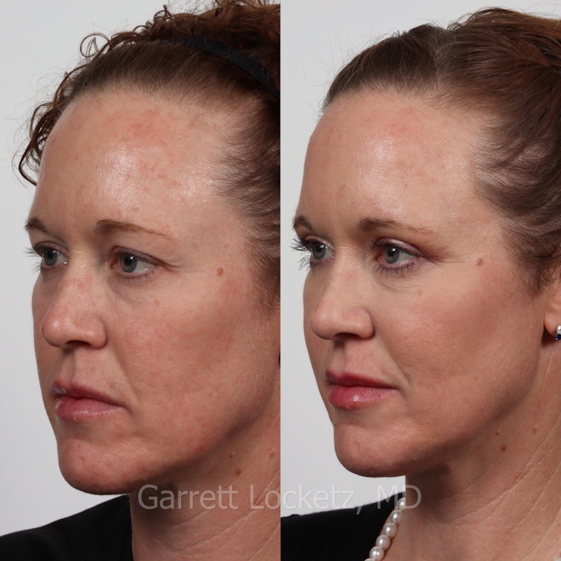 Eyelid Surgery (Blepharoplasty) Before & After Gallery - Patient 196499775 - Image 1
