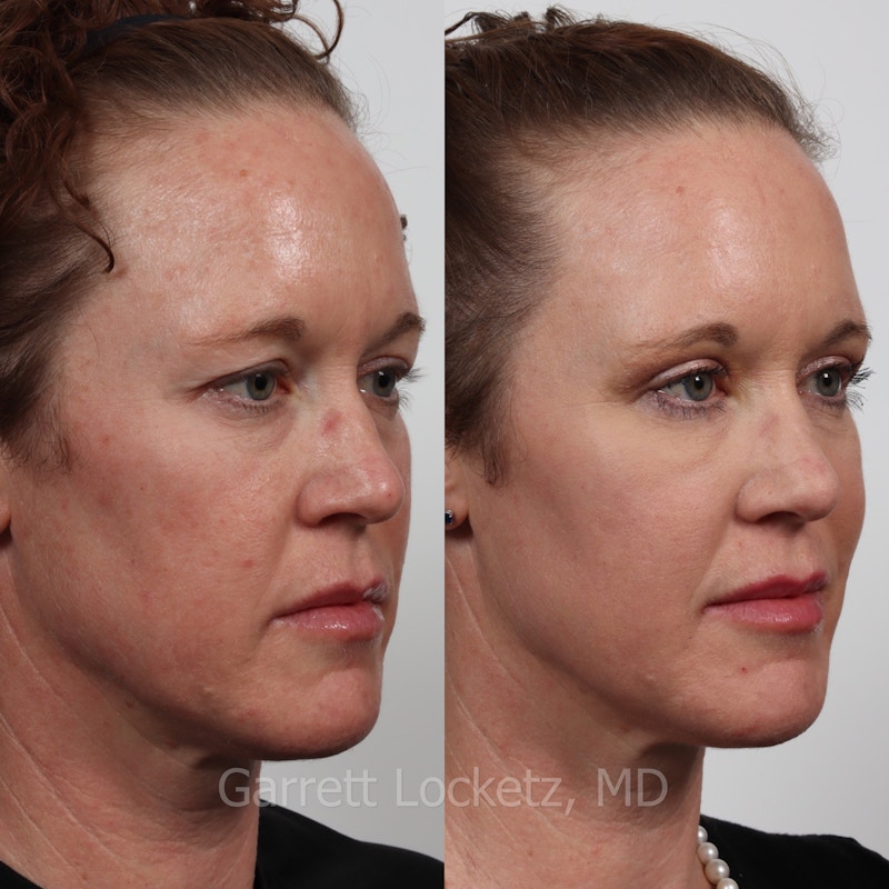 Eyelid Surgery (Blepharoplasty) Before & After Gallery - Patient 196499776 - Image 1