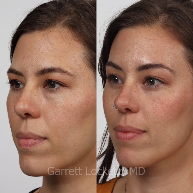 Brow Lift Before & After Gallery - Patient 196499828 - Image 1