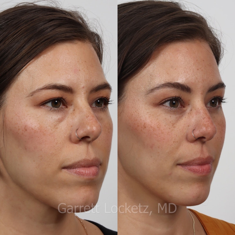 Brow Lift Before & After Gallery - Patient 196499829 - Image 1