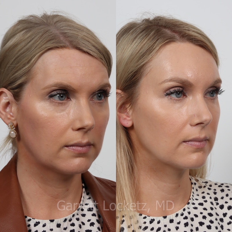 Brow Lift Before & After Gallery - Patient 196499830 - Image 1