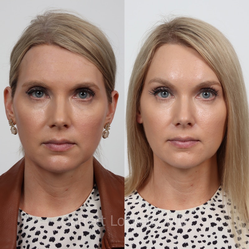 Brow Lift Before & After Gallery - Patient 196499831 - Image 1