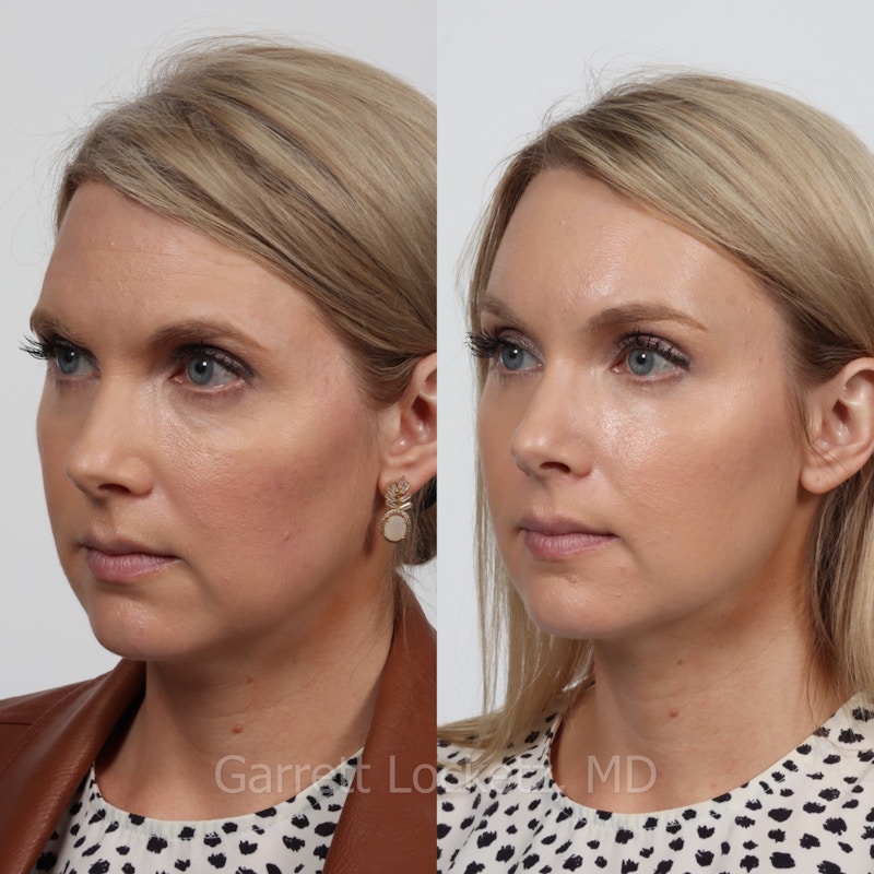 Brow Lift Before & After Gallery - Patient 196499832 - Image 1