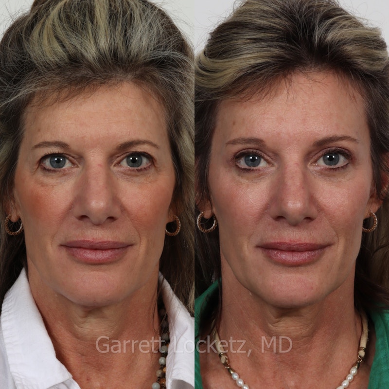 Brow Lift Before & After Gallery - Patient 196499833 - Image 1