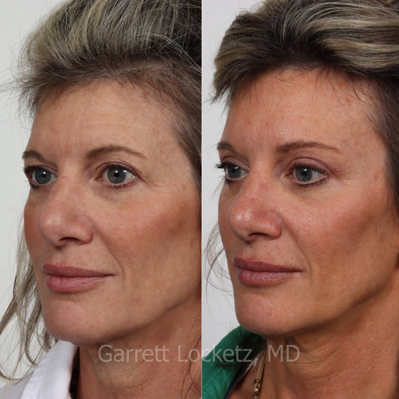 Brow Lift Before & After Gallery - Patient 196499834 - Image 1