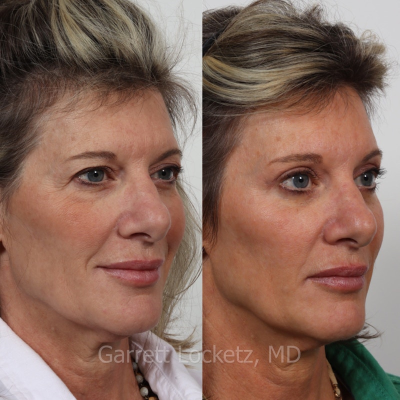 Brow Lift Before & After Gallery - Patient 196499835 - Image 1