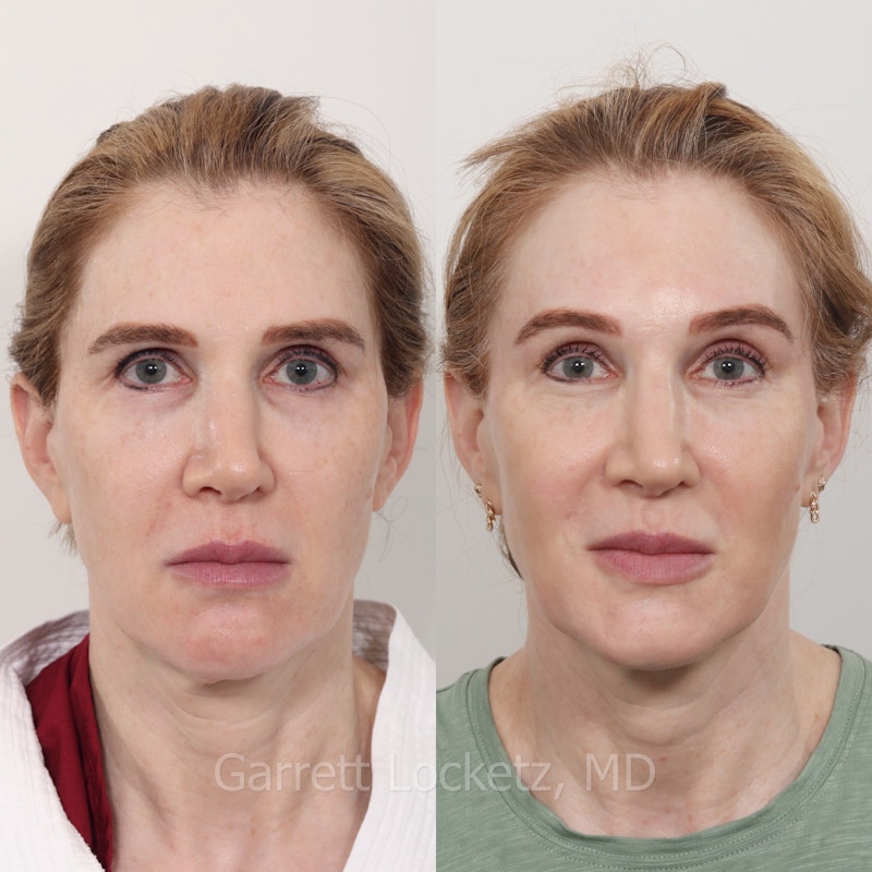 Brow Lift Before & After Gallery - Patient 196499836 - Image 1