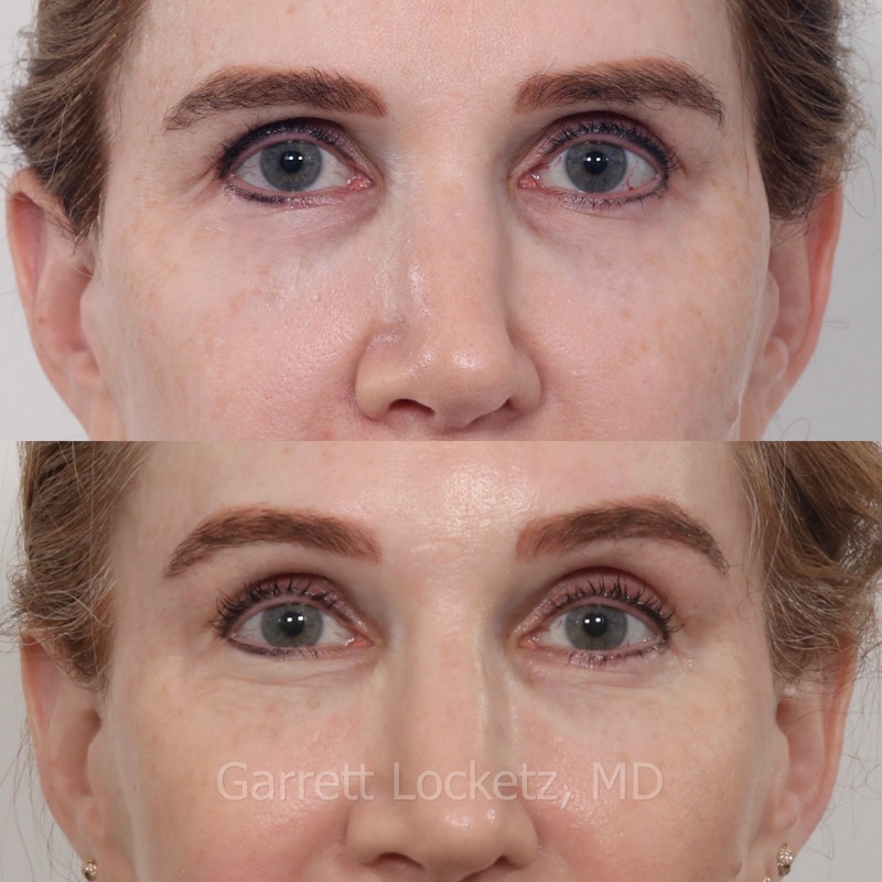 Brow Lift Before & After Gallery - Patient 196499837 - Image 1