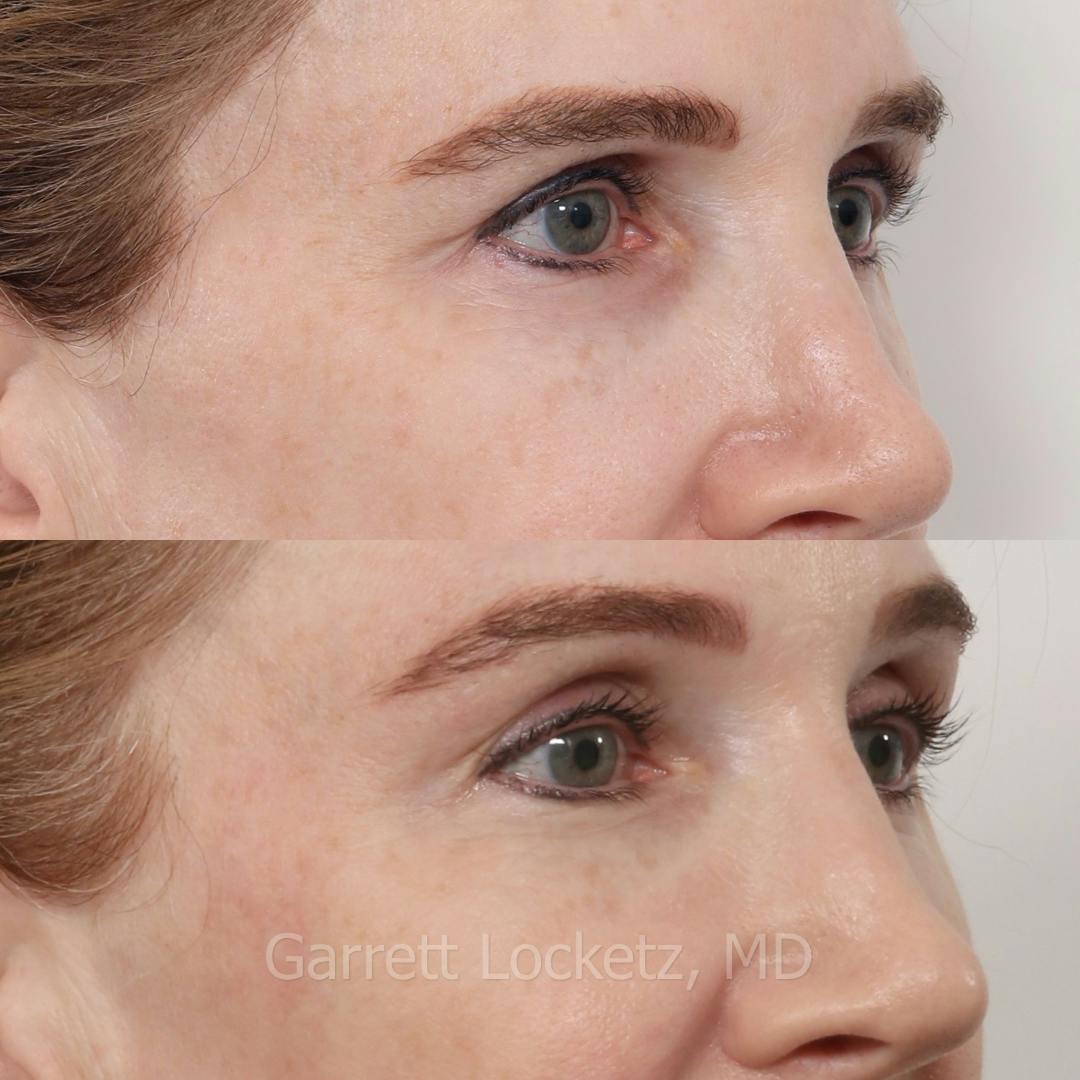 Brow Lift Before & After Gallery - Patient 196499838 - Image 1