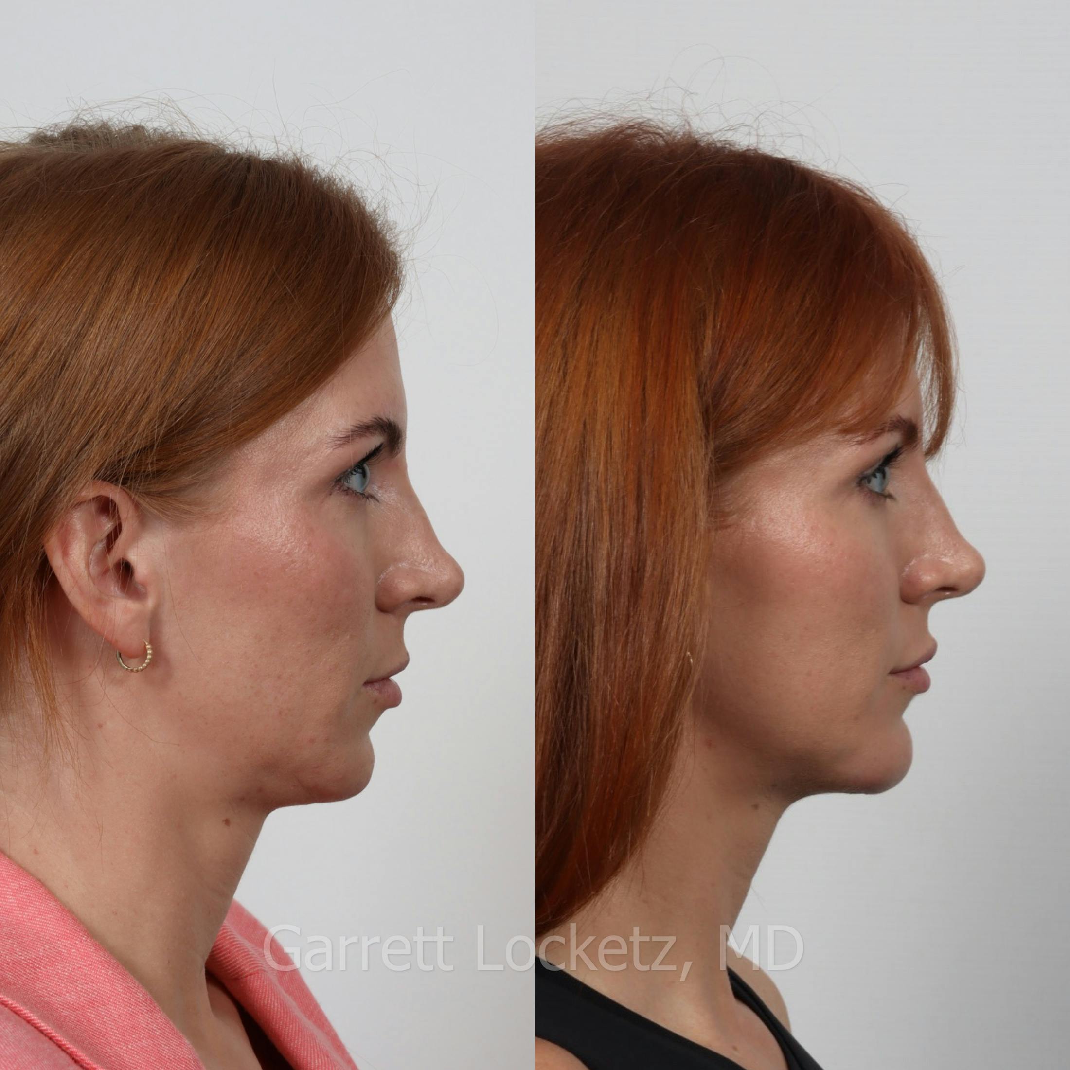 Chin Implant Before & After Gallery - Patient 196509844 - Image 1