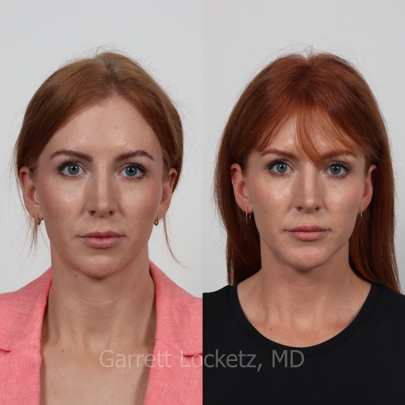 Chin Implant Before & After Gallery - Patient 196509845 - Image 1