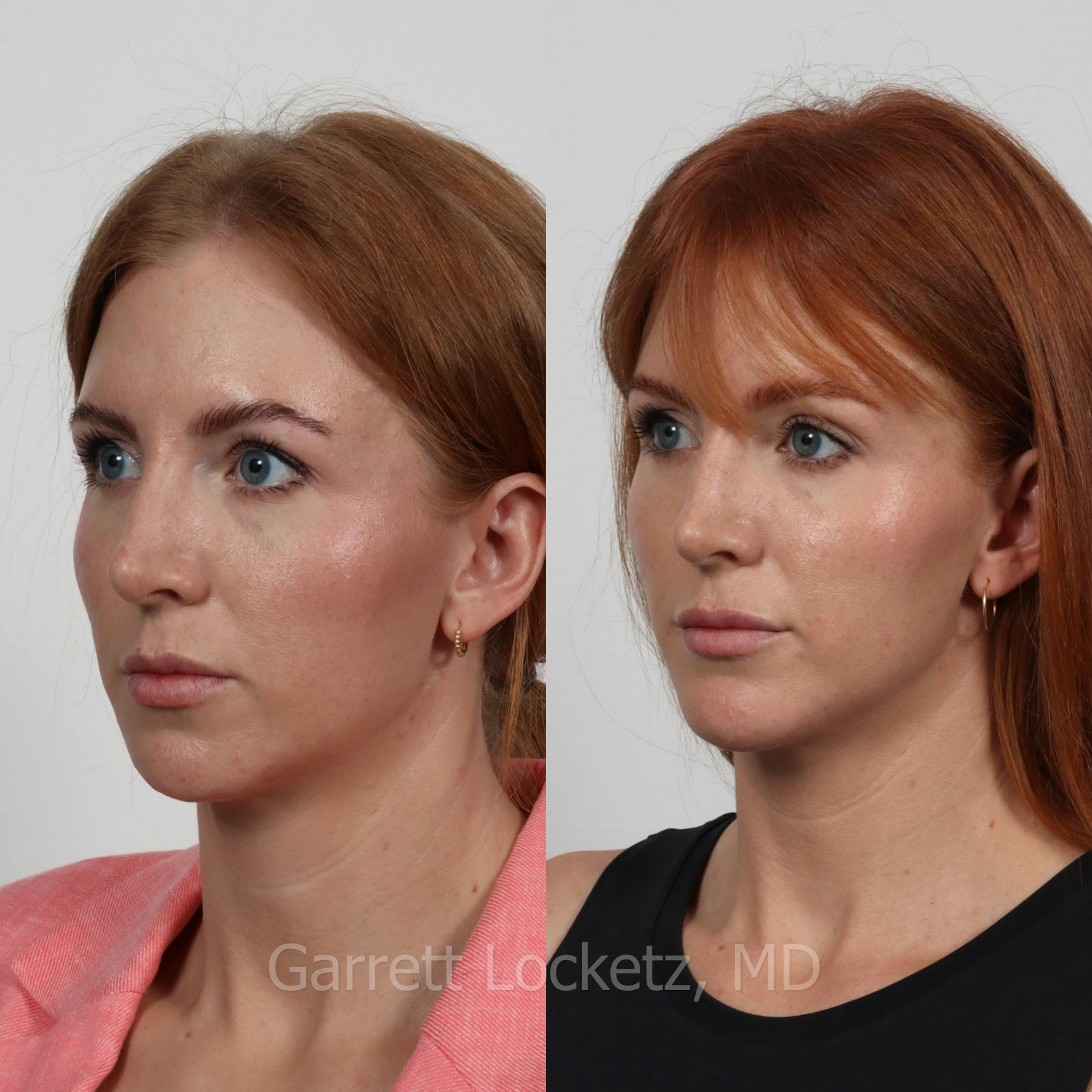 Chin Implant Before & After Gallery - Patient 196509846 - Image 1