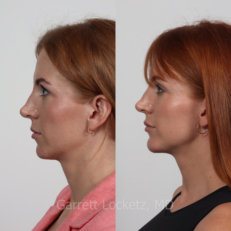 Chin Implant Before & After Gallery - Patient 196509847 - Image 1