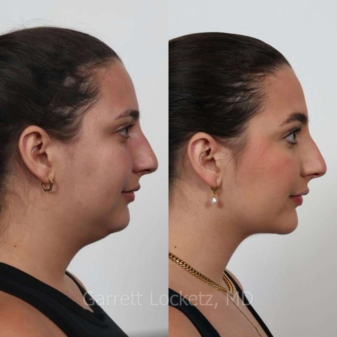 Chin Implant Before & After Gallery - Patient 196509848 - Image 1