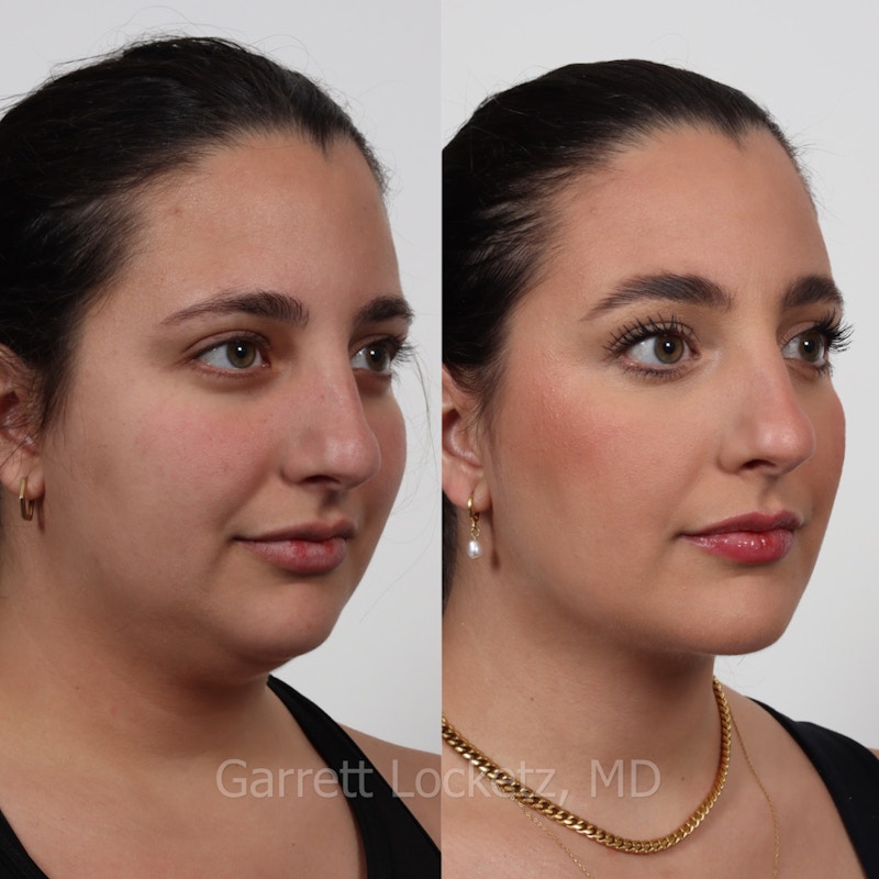 Chin Implant Before & After Gallery - Patient 196509849 - Image 1