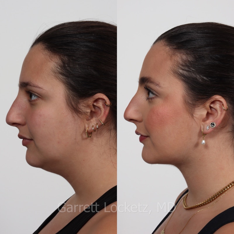 Chin Implant Before & After Gallery - Patient 196509850 - Image 1