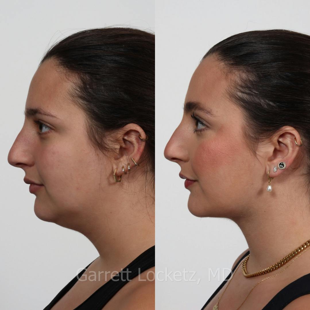 Chin Implant Before & After Gallery - Patient 196509850 - Image 1