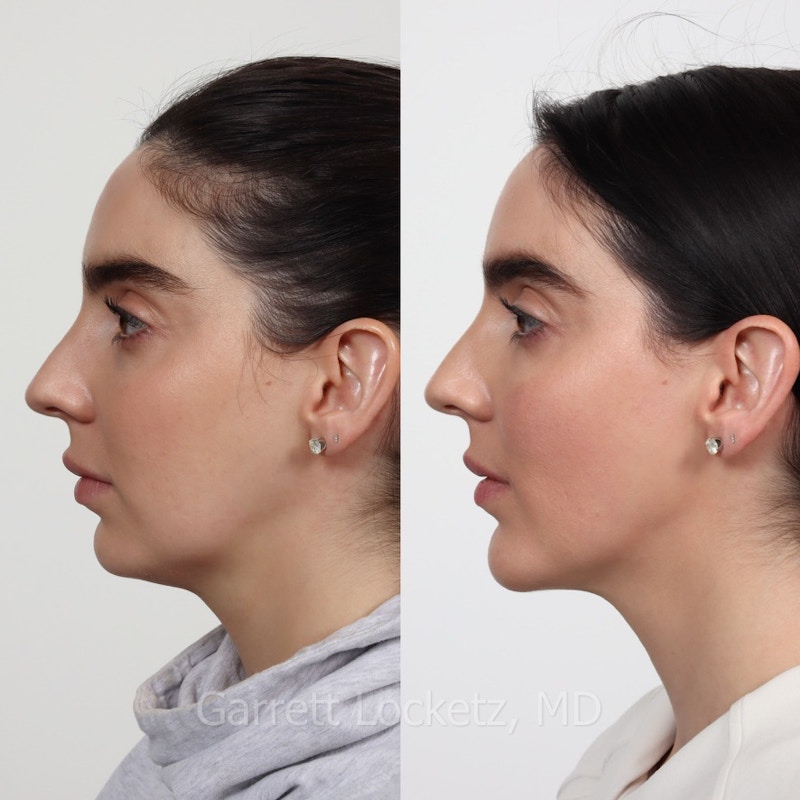 Chin Implant Before & After Gallery - Patient 196509852 - Image 1