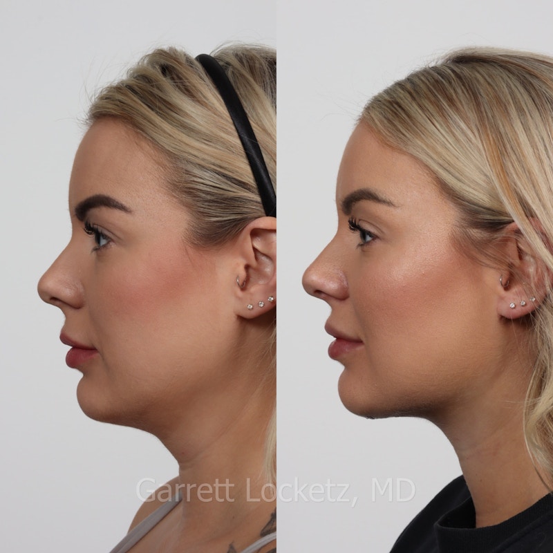 Deep Neck Lift Before & After Gallery - Patient 196509884 - Image 1